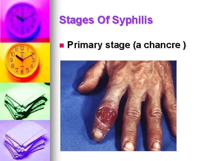 Stages Of Syphilis n Primary stage (a chancre ) Stages Of Syphilis n Primary stage (a chancre )