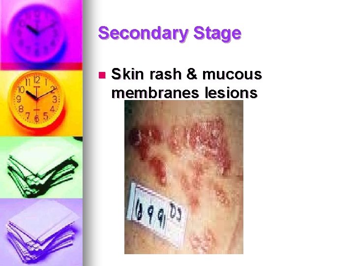 Secondary Stage n Skin rash & mucous membranes lesions Secondary Stage n Skin rash & mucous membranes lesions