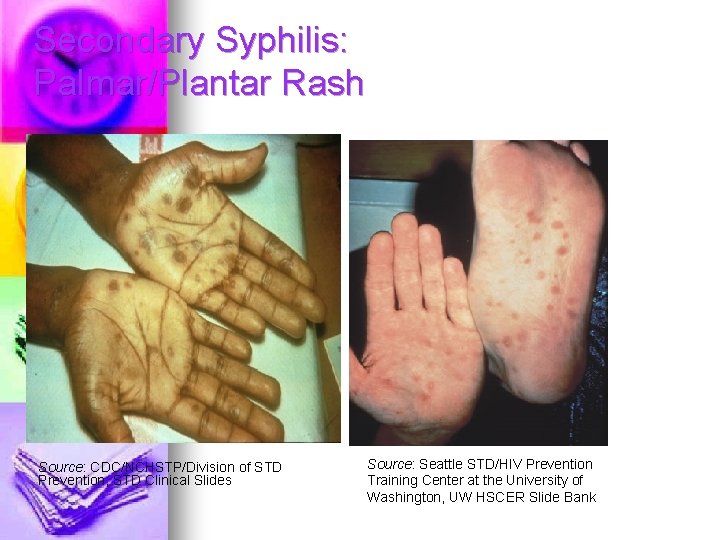 Secondary Syphilis: Palmar/Plantar Rash Source: CDC/NCHSTP/Division of STD Prevention, STD Clinical Slides Source: Seattle Secondary Syphilis: Palmar/Plantar Rash Source: CDC/NCHSTP/Division of STD Prevention, STD Clinical Slides Source: Seattle