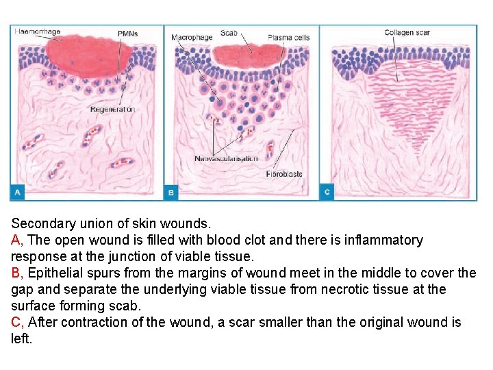 Secondary union of skin wounds. A, The open wound is filled with blood clot