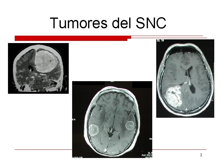 Tumores del SNC 1 