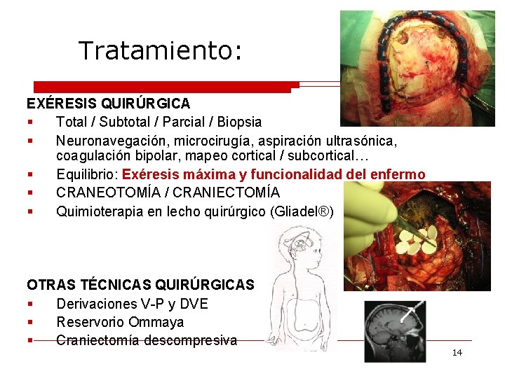 Tratamiento: EXÉRESIS QUIRÚRGICA § Total / Subtotal / Parcial / Biopsia § Neuronavegación, microcirugía,
