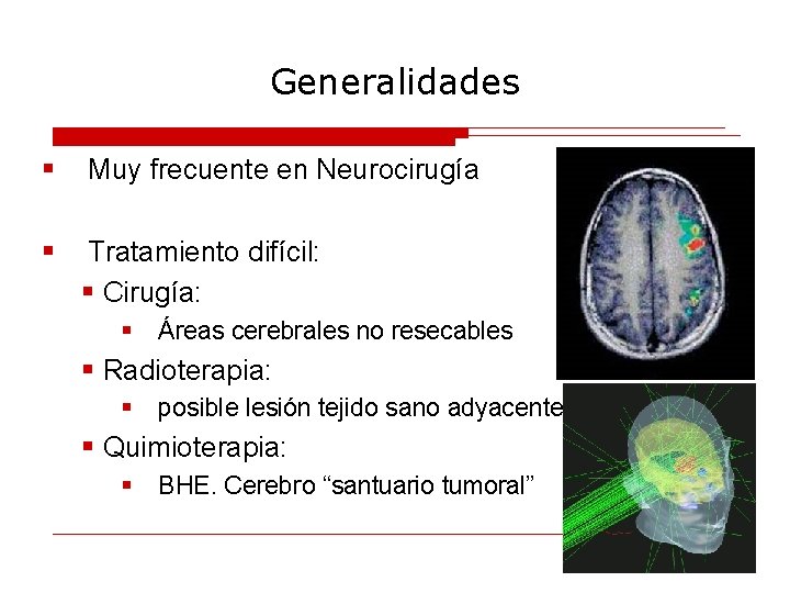 Generalidades § Muy frecuente en Neurocirugía § Tratamiento difícil: § Cirugía: § Áreas cerebrales