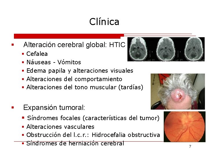 Clínica § Alteración cerebral global: HTIC § § § Cefalea Náuseas - Vómitos Edema