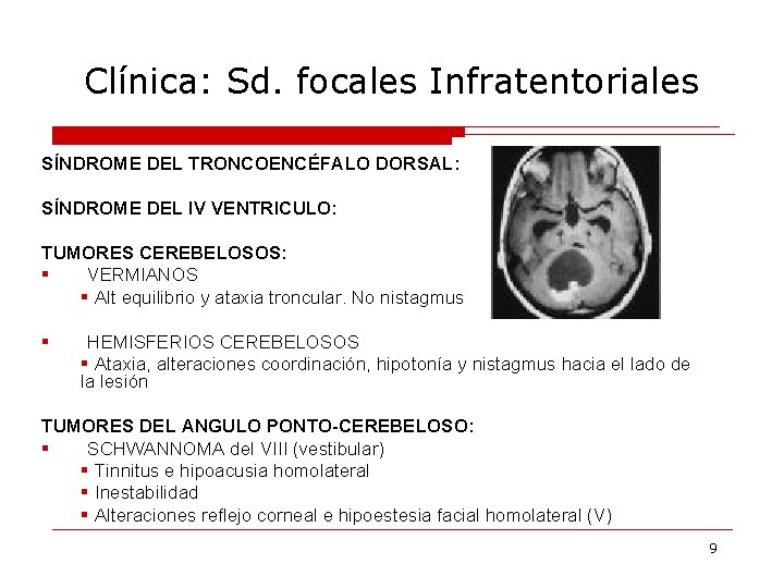 Clínica: Sd. focales Infratentoriales SÍNDROME DEL TRONCOENCÉFALO DORSAL: SÍNDROME DEL IV VENTRICULO: TUMORES CEREBELOSOS: