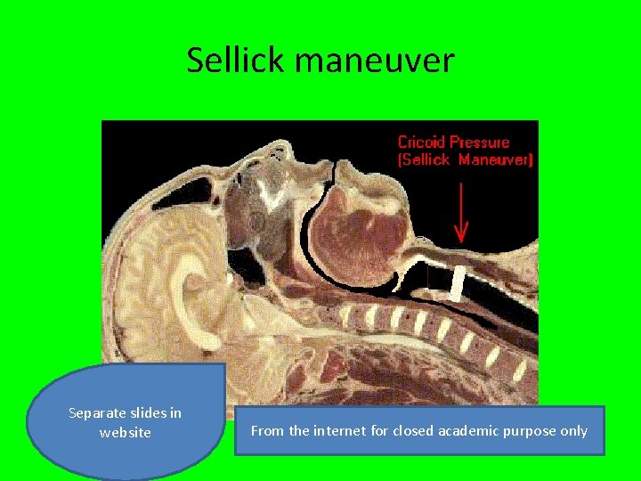 Sellick maneuver Separate slides in website From the internet for closed academic purpose only