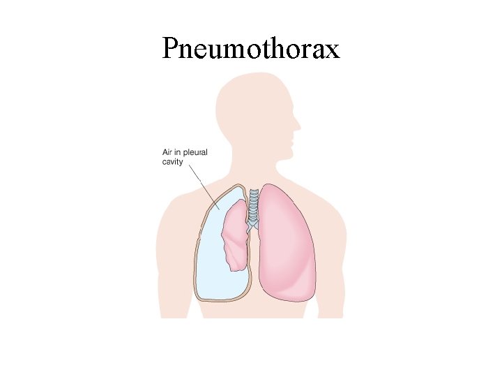 Pneumothorax 