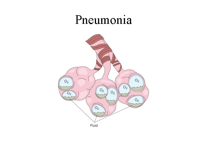 Pneumonia 