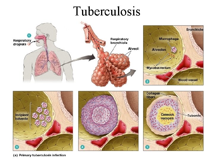 Tuberculosis 