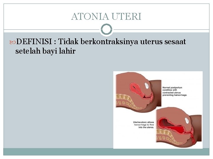 ATONIA UTERI DEFINISI : Tidak berkontraksinya uterus sesaat setelah bayi lahir 