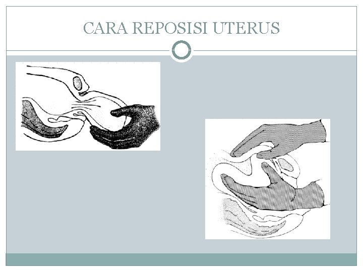 CARA REPOSISI UTERUS 