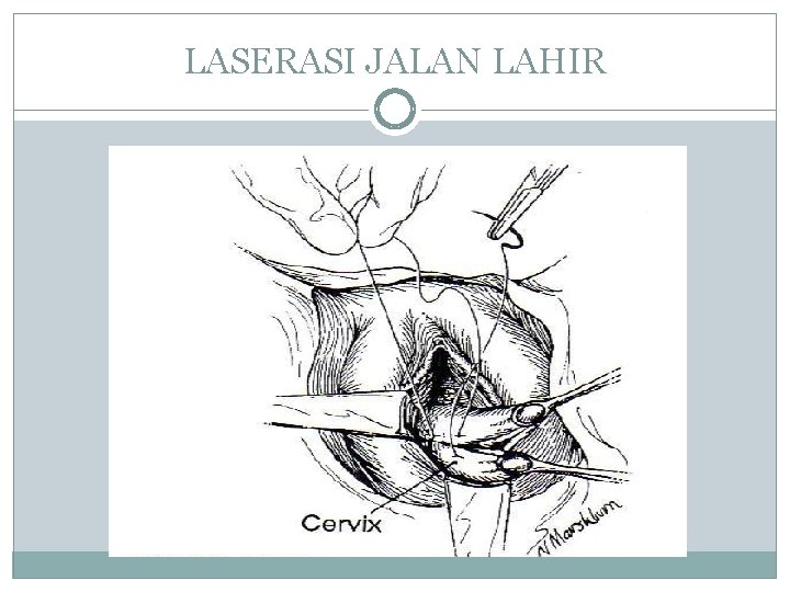 LASERASI JALAN LAHIR 