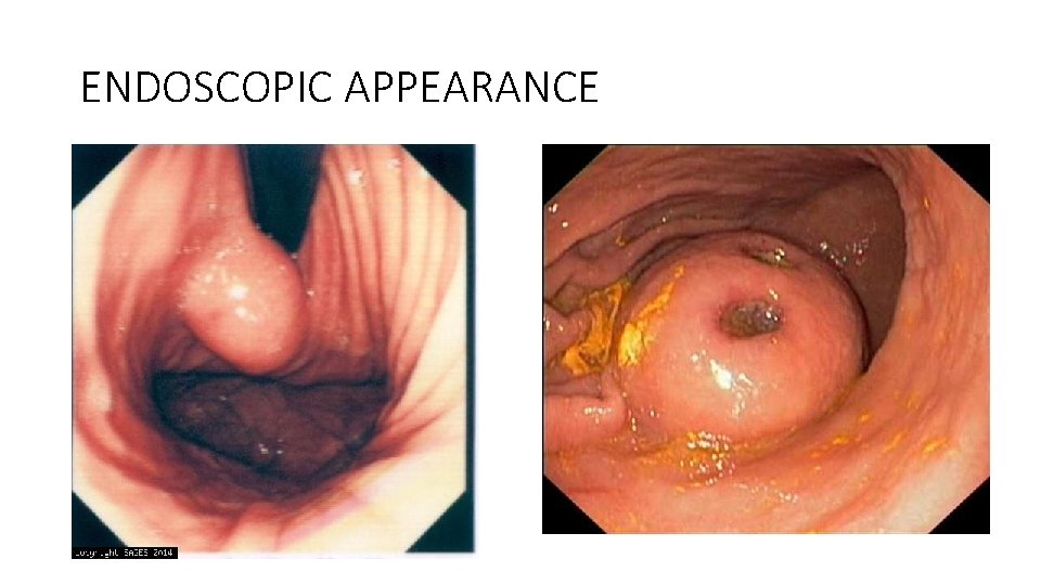 ENDOSCOPIC APPEARANCE 