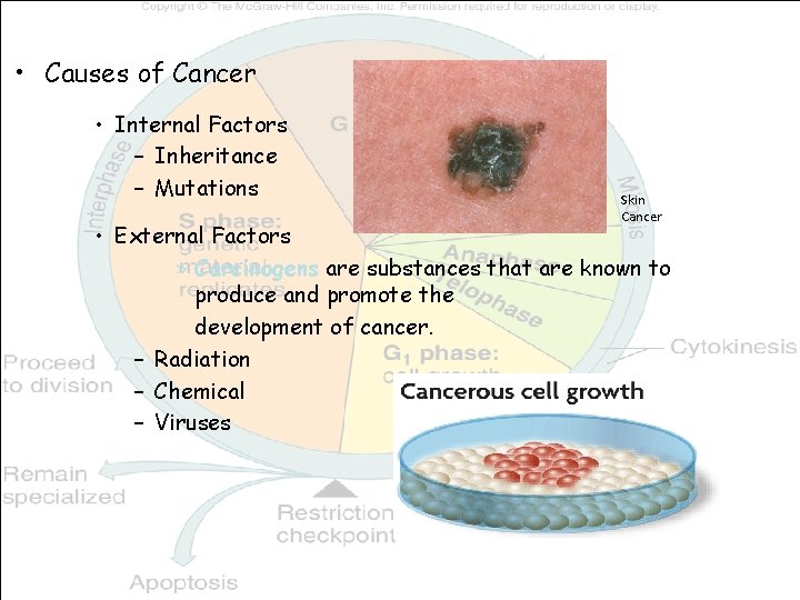  • Causes of Cancer • Internal Factors – Inheritance – Mutations Skin Cancer