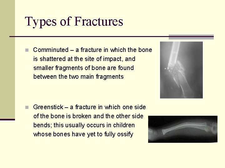 Types of Fractures n Comminuted – a fracture in which the bone is shattered