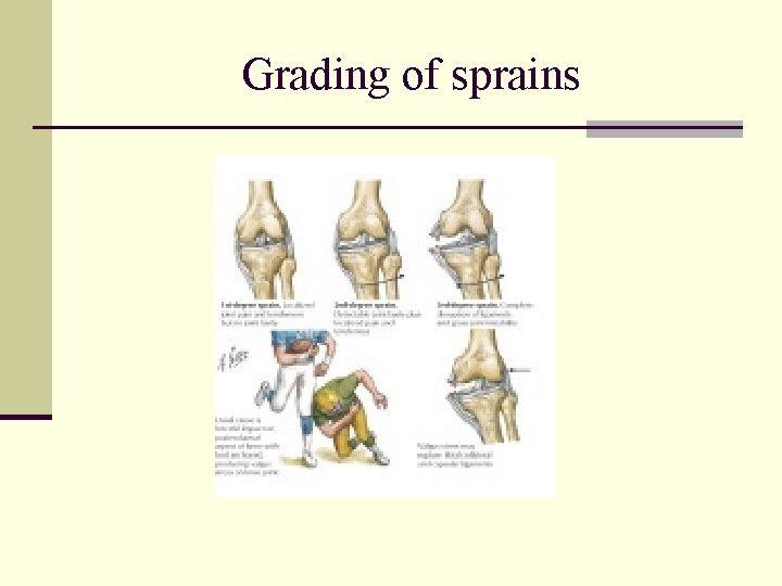 Grading of sprains 