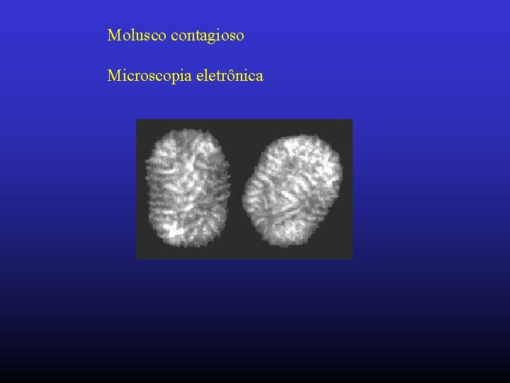 Molusco contagioso Microscopia eletrônica 