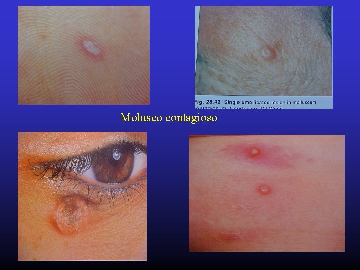 Molusco contagioso 