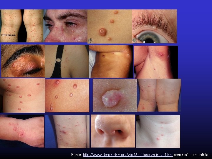 Fonte: http: //www. dermnetnz. org/viral/molluscum-imgs. html permissão concedida 