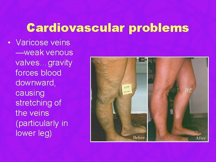 Cardiovascular problems • Varicose veins —weak venous valves…gravity forces blood downward, causing stretching of Cardiovascular problems • Varicose veins —weak venous valves…gravity forces blood downward, causing stretching of