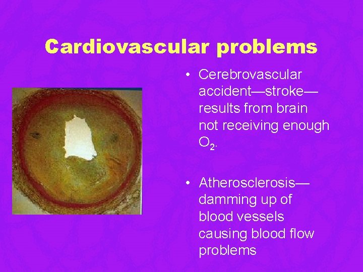 Cardiovascular problems • Cerebrovascular accident—stroke— results from brain not receiving enough O 2. • Cardiovascular problems • Cerebrovascular accident—stroke— results from brain not receiving enough O 2. •
