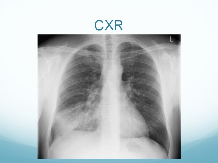 CXR 