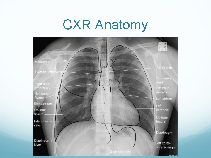 CXR Anatomy 