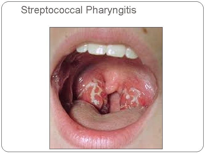 Streptococcal Pharyngitis 