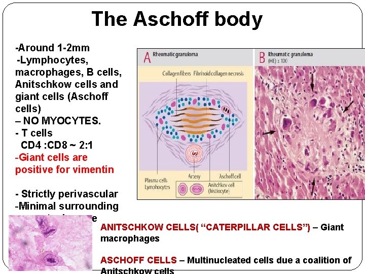 The Aschoff body -Around 1 -2 mm -Lymphocytes, macrophages, B cells, Anitschkow cells and