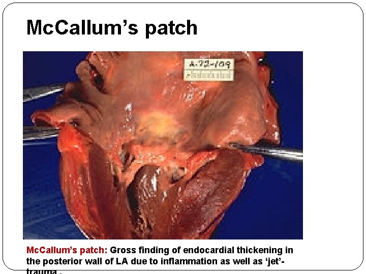 Mc. Callum’s patch: Gross finding of endocardial thickening in the posterior wall of LA