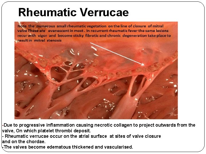 Rheumatic Verrucae -Due to progressive inflammation causing necrotic collagen to project outwards from the