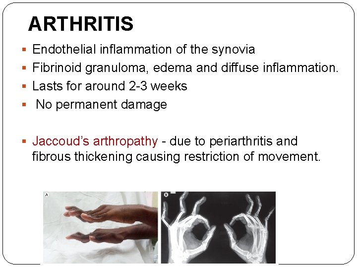 ARTHRITIS § Endothelial inflammation of the synovia § Fibrinoid granuloma, edema and diffuse inflammation.