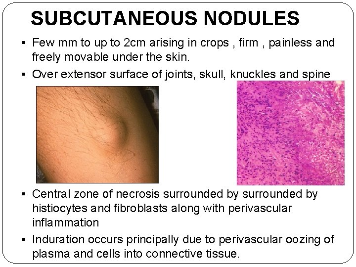 SUBCUTANEOUS NODULES § Few mm to up to 2 cm arising in crops ,