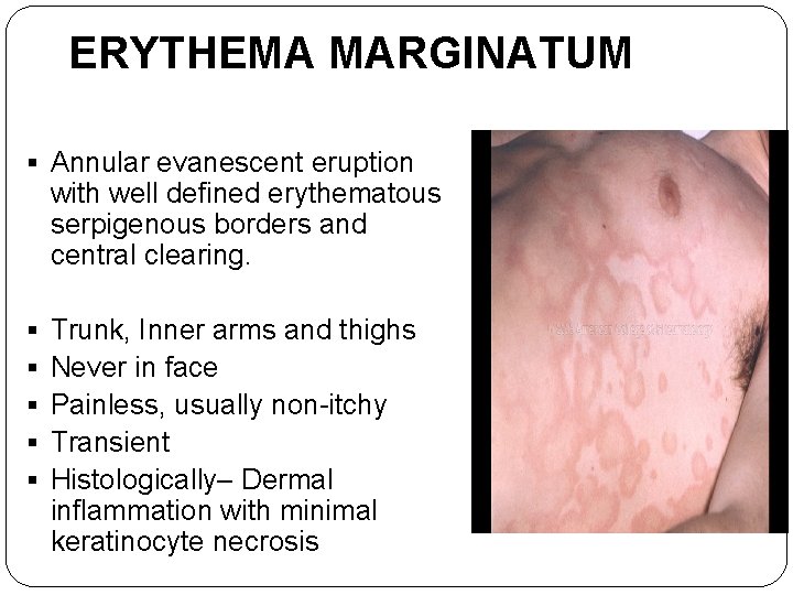 ERYTHEMA MARGINATUM § Annular evanescent eruption with well defined erythematous serpigenous borders and central