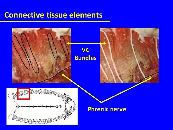 Connective tissue elements VC Bundles Phrenic nerve 