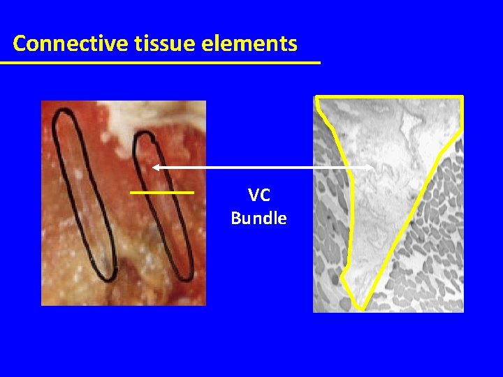 Connective tissue elements VC Bundle 