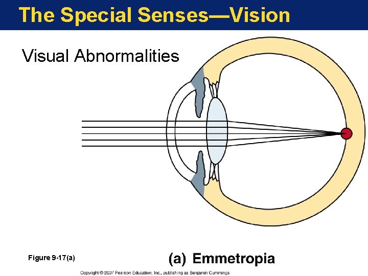 The Special Senses—Vision Visual Abnormalities Figure 9 -17(a) 