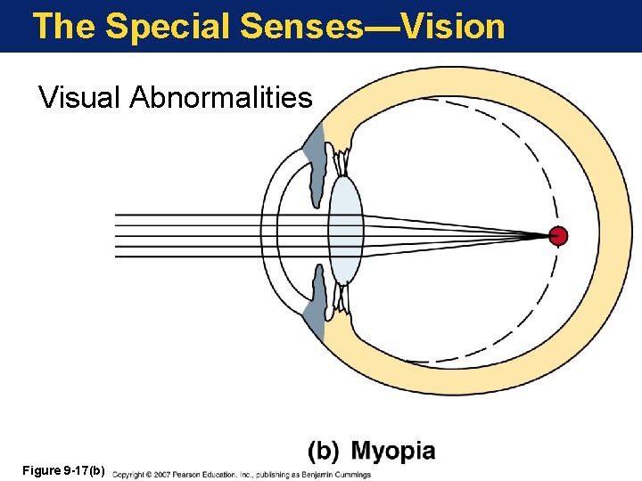 The Special Senses—Vision Visual Abnormalities Figure 9 -17(b) 