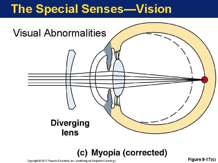 The Special Senses—Vision Visual Abnormalities Figure 9 -17(c) 