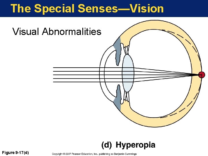 The Special Senses—Vision Visual Abnormalities Figure 9 -17(d) 