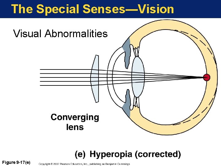 The Special Senses—Vision Visual Abnormalities Figure 9 -17(e) 