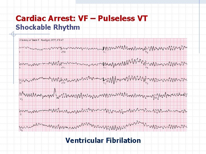 Cardiac Arrest: VF – Pulseless VT Shockable Rhythm Ventricular Fibrilation 
