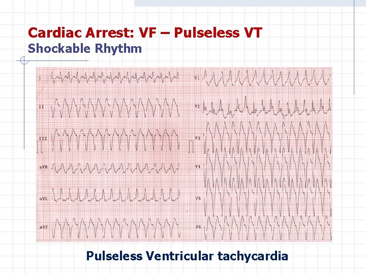 Cardiac Arrest: VF – Pulseless VT Shockable Rhythm Pulseless Ventricular tachycardia 