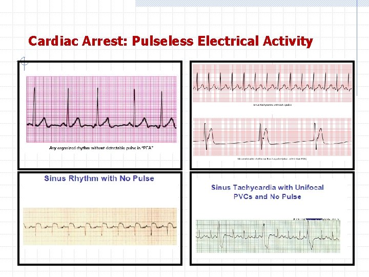 Cardiac Arrest: Pulseless Electrical Activity 
