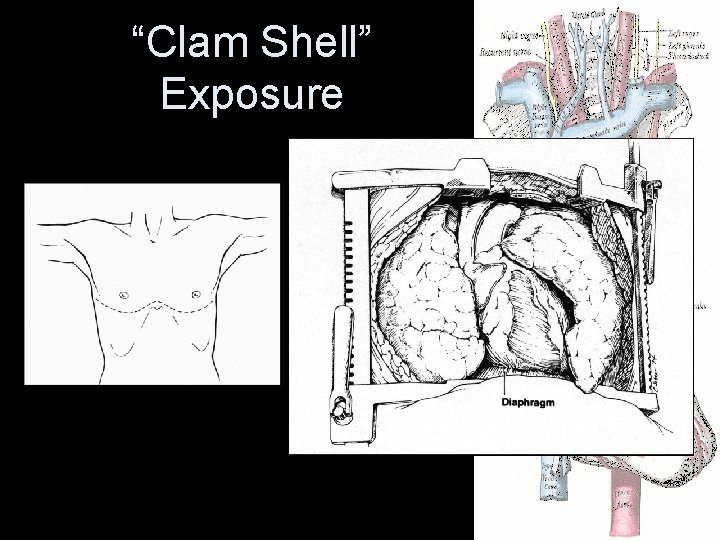 “Clam Shell” Exposure “Clam Shell” Exposure