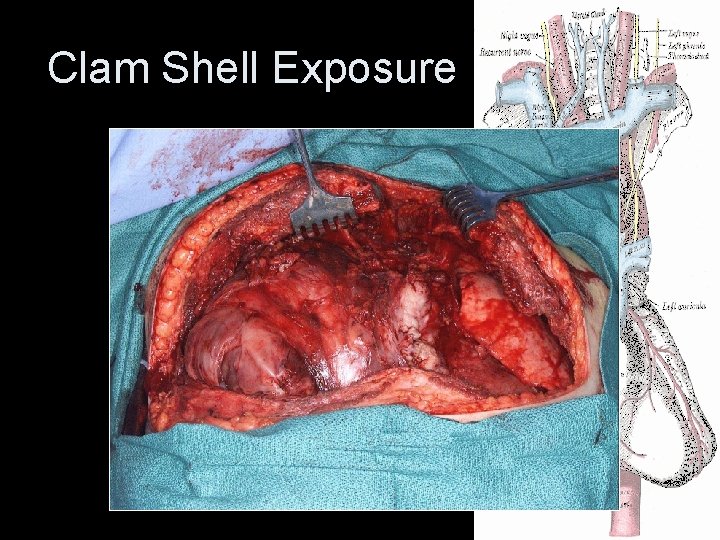 Clam Shell Exposure Clam Shell Exposure