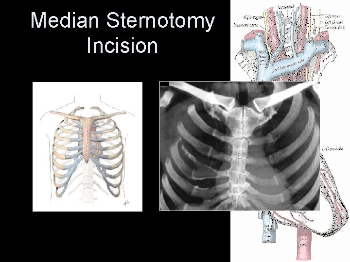 Median Sternotomy Incision Median Sternotomy Incision