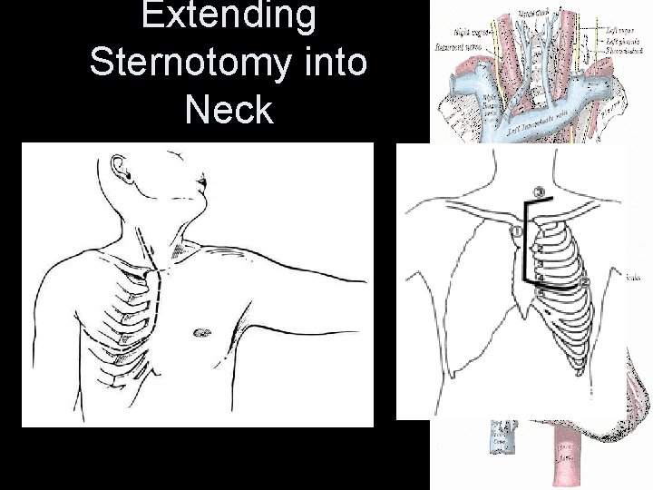 Extending Sternotomy into Neck Extending Sternotomy into Neck