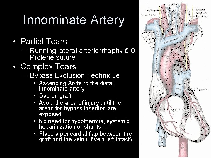 Innominate Artery • Partial Tears – Running lateral arteriorrhaphy 5 -0 Prolene suture • Innominate Artery • Partial Tears – Running lateral arteriorrhaphy 5 -0 Prolene suture •