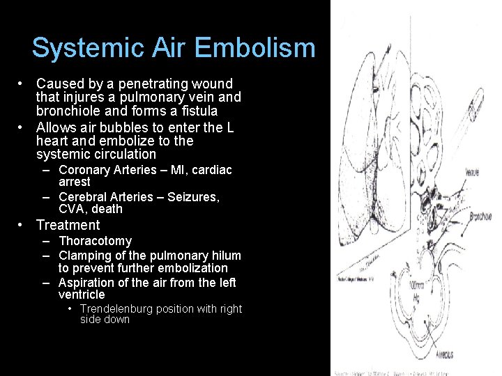 Systemic Air Embolism • Caused by a penetrating wound that injures a pulmonary vein Systemic Air Embolism • Caused by a penetrating wound that injures a pulmonary vein